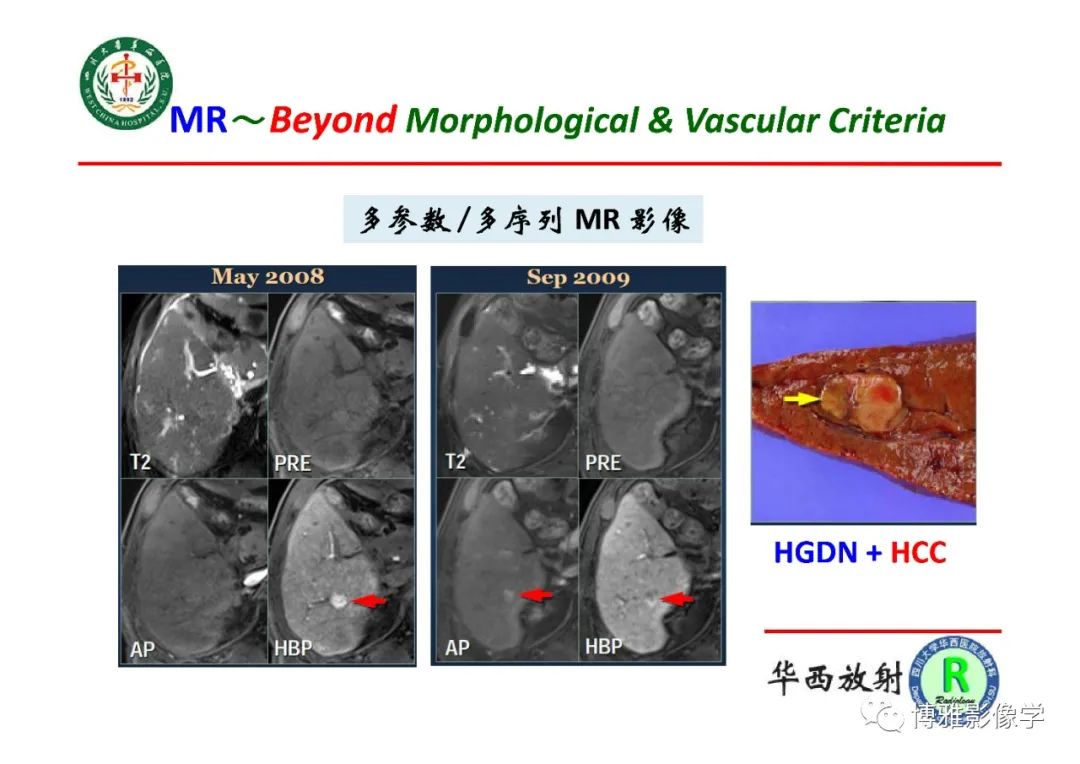 影像PPT - 【PPT】肝硬化结节多步癌变的影像学评价-30