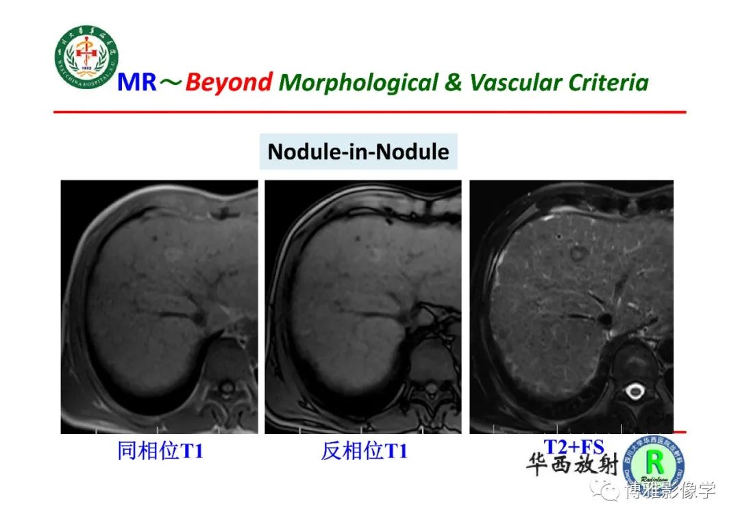 影像PPT - 【PPT】肝硬化结节多步癌变的影像学评价-31