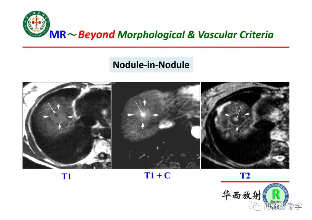 影像PPT - 【PPT】肝硬化结节多步癌变的影像学评价-32