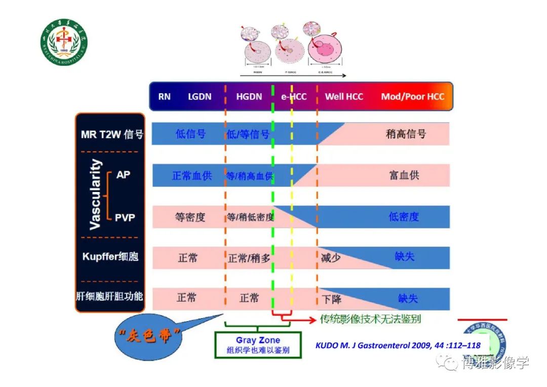 影像PPT - 【PPT】肝硬化结节多步癌变的影像学评价-34