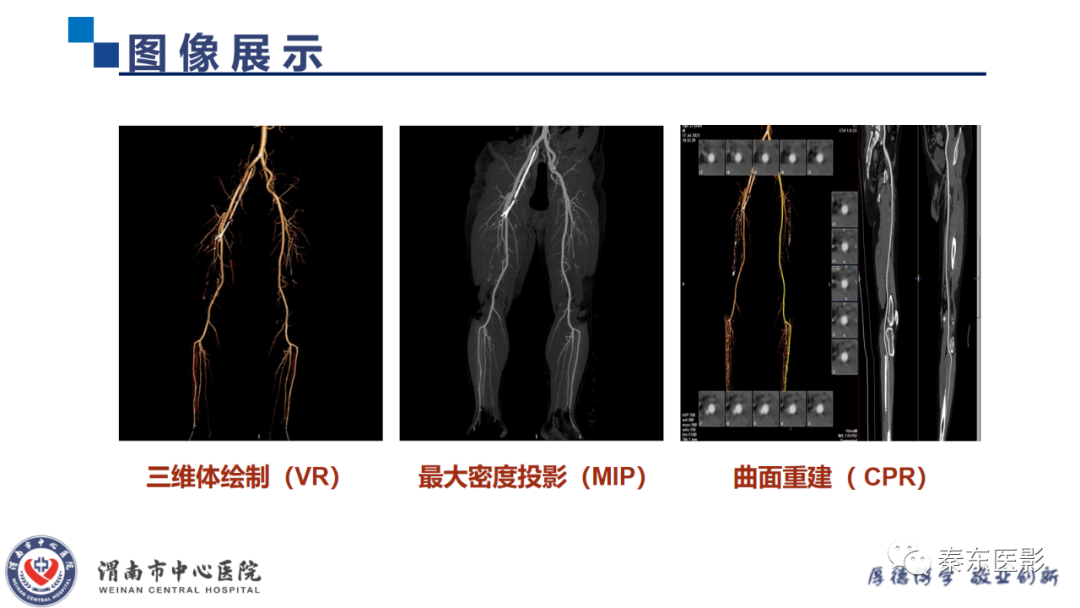 影像PPT - 【PPT】双下肢CTA检查技术-11