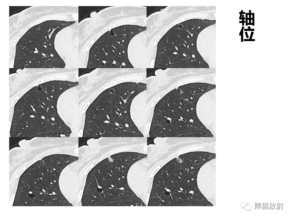 影像PPT - 【病例】肺部囊腔样病变2例CT鉴别-4