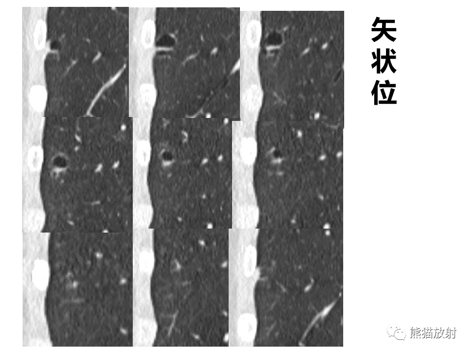 影像PPT - 【病例】肺部囊腔样病变2例CT鉴别-6