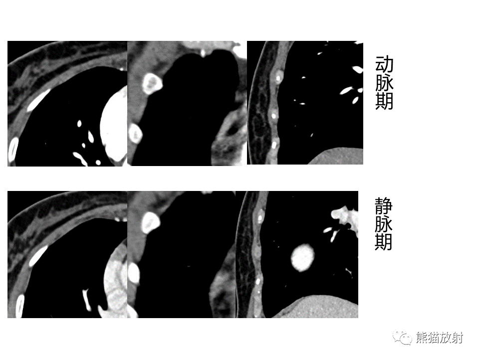 影像PPT - 【病例】肺部囊腔样病变2例CT鉴别-7
