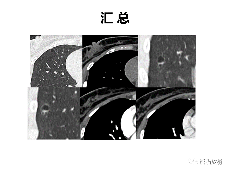 影像PPT - 【病例】肺部囊腔样病变2例CT鉴别-8