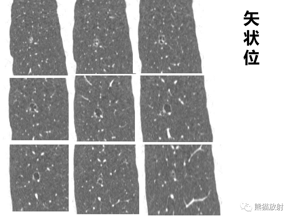 影像PPT - 【病例】肺部囊腔样病变2例CT鉴别-14