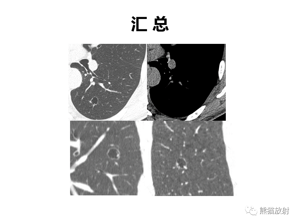 影像PPT - 【病例】肺部囊腔样病变2例CT鉴别-16