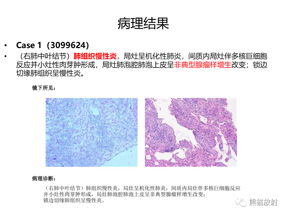 影像PPT - 【病例】肺部囊腔样病变2例CT鉴别-17
