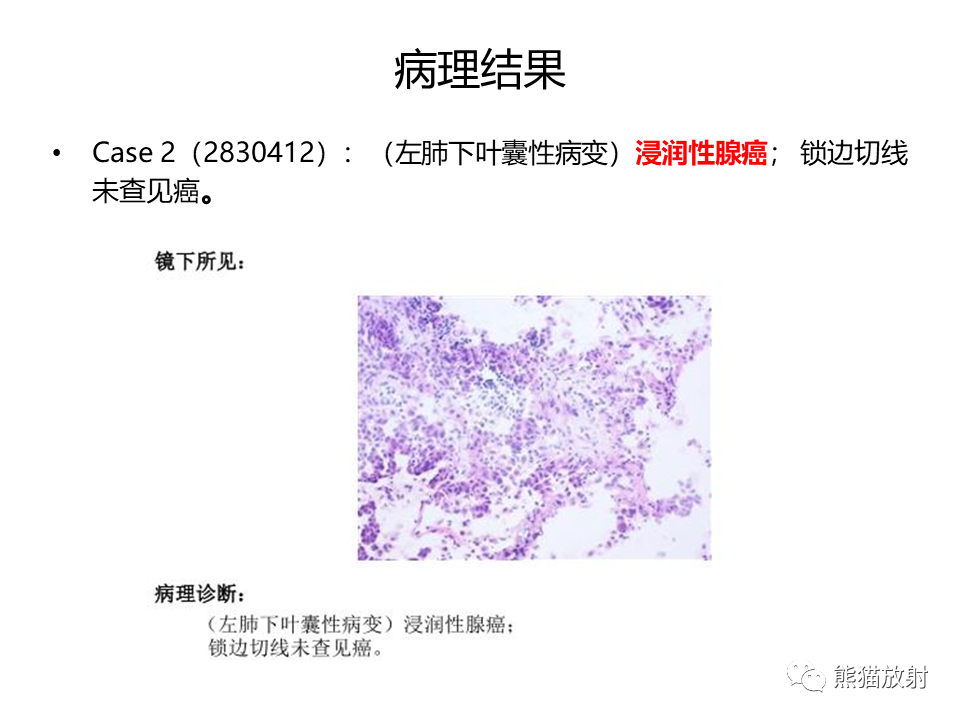 影像PPT - 【病例】肺部囊腔样病变2例CT鉴别-18