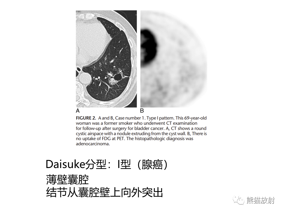 影像PPT - 【病例】肺部囊腔样病变2例CT鉴别-23