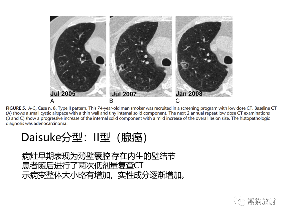 影像PPT - 【病例】肺部囊腔样病变2例CT鉴别-24