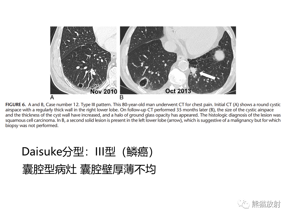 影像PPT - 【病例】肺部囊腔样病变2例CT鉴别-25