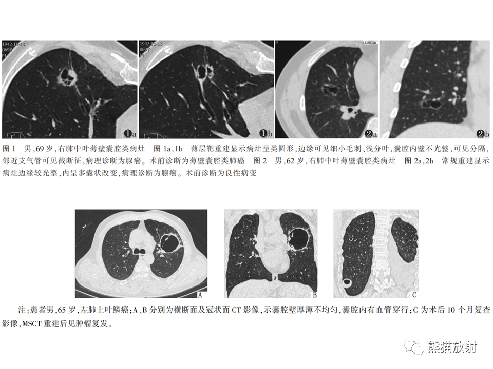影像PPT - 【病例】肺部囊腔样病变2例CT鉴别-29