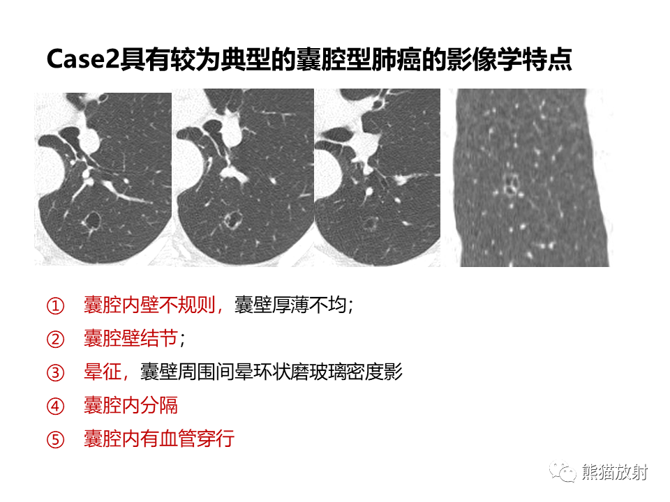 影像PPT - 【病例】肺部囊腔样病变2例CT鉴别-30