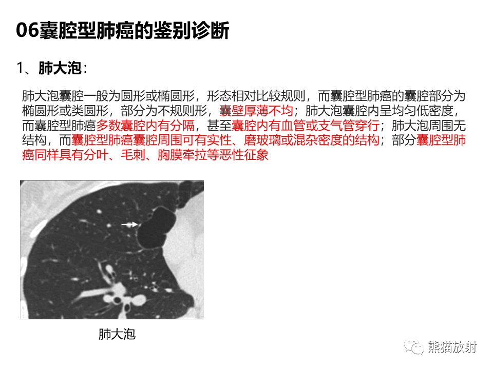 影像PPT - 【病例】肺部囊腔样病变2例CT鉴别-32