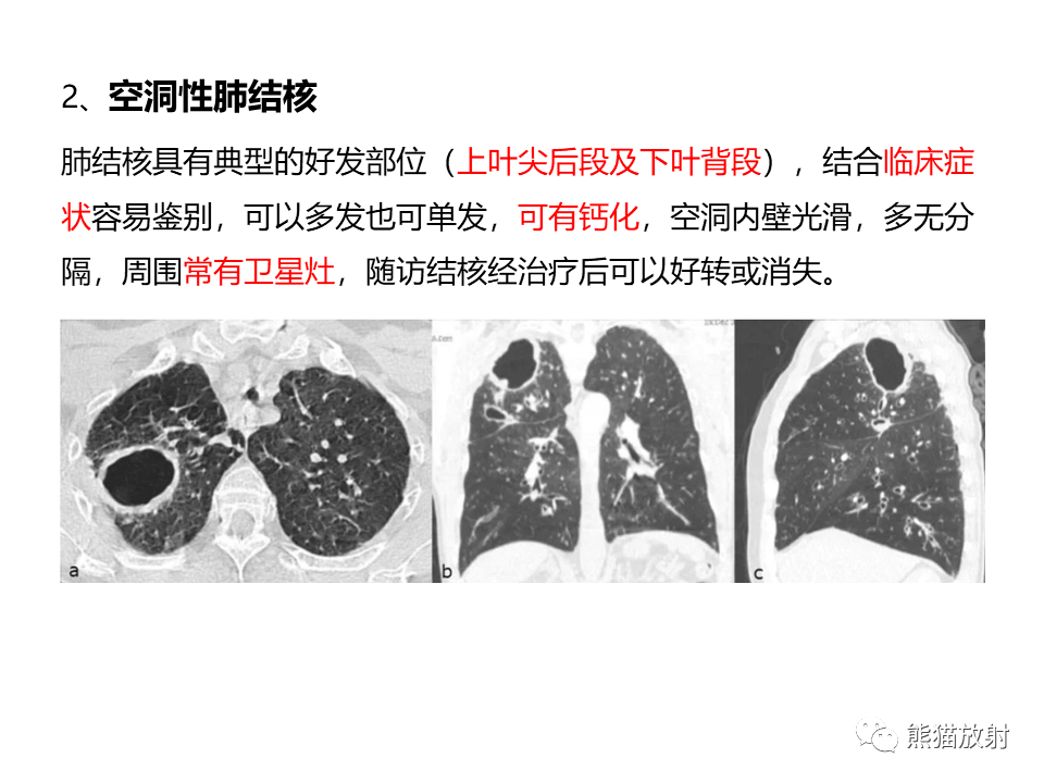 影像PPT - 【病例】肺部囊腔样病变2例CT鉴别-33