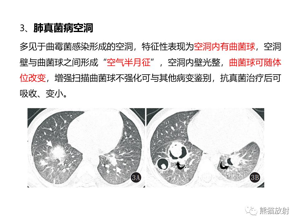 影像PPT - 【病例】肺部囊腔样病变2例CT鉴别-34