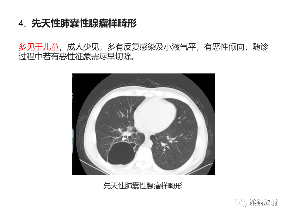 影像PPT - 【病例】肺部囊腔样病变2例CT鉴别-35