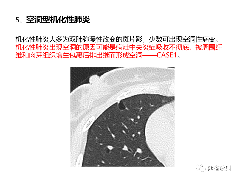 影像PPT - 【病例】肺部囊腔样病变2例CT鉴别-36