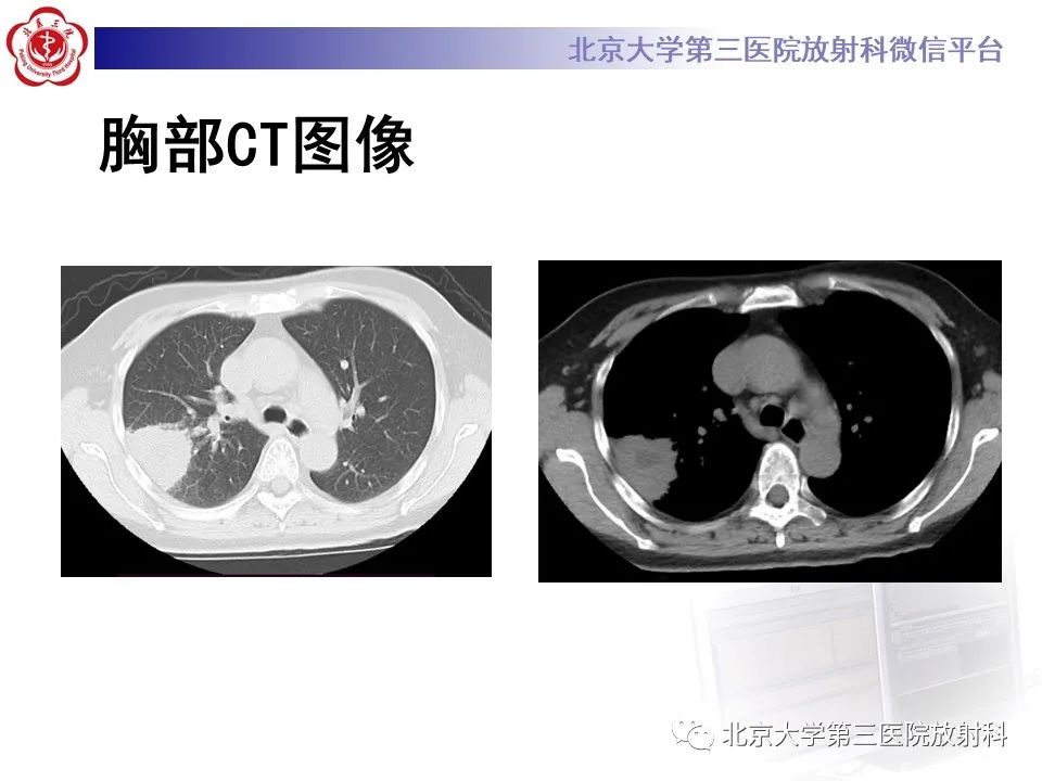 影像PPT - 【PPT】肺放线菌-3