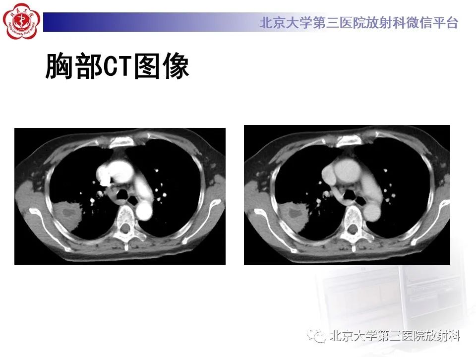影像PPT - 【PPT】肺放线菌-4