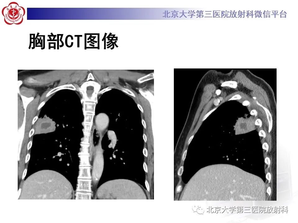 影像PPT - 【PPT】肺放线菌-5