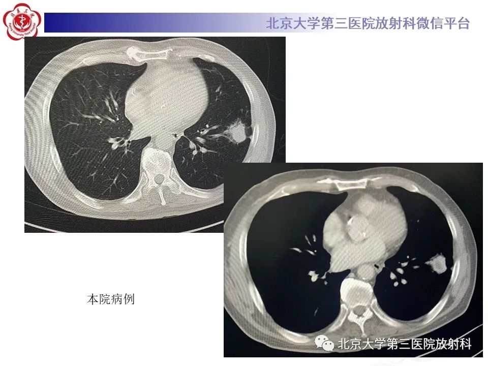 影像PPT - 【PPT】肺放线菌-13