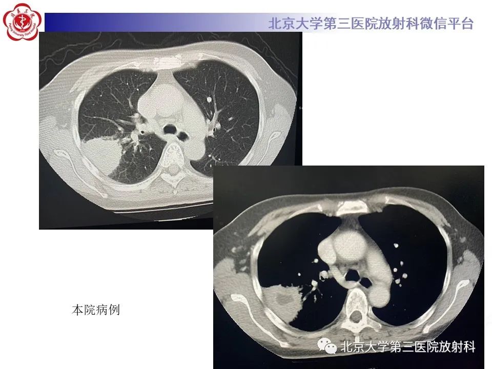 影像PPT - 【PPT】肺放线菌-14