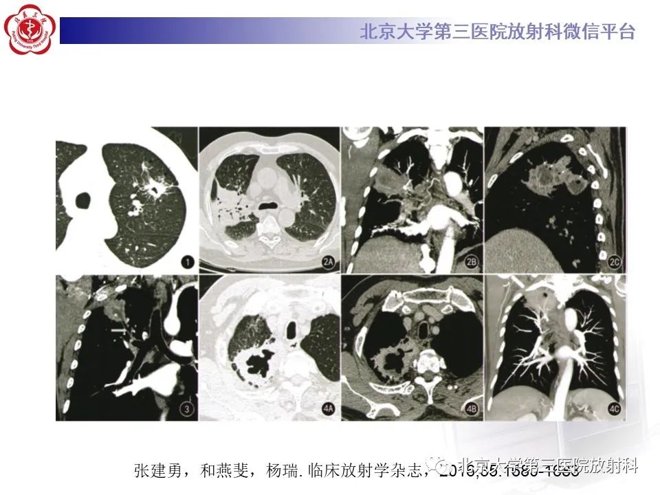 影像PPT - 【PPT】肺放线菌-15
