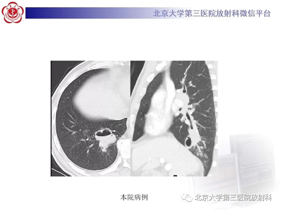 影像PPT - 【PPT】肺放线菌-18
