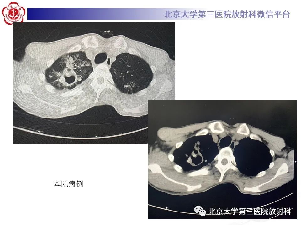 影像PPT - 【PPT】肺放线菌-20