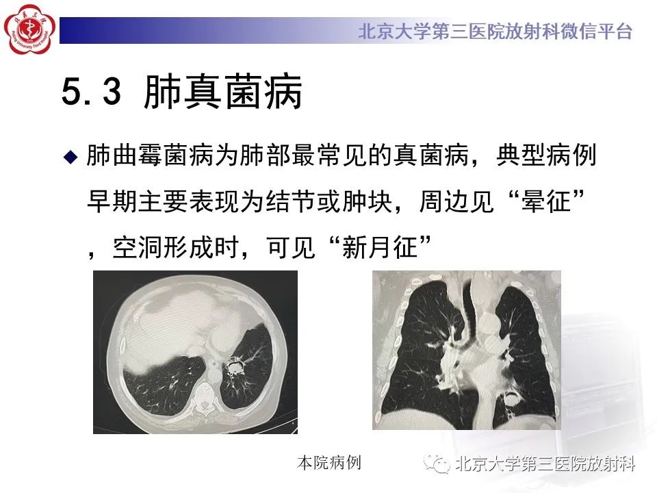 影像PPT - 【PPT】肺放线菌-21