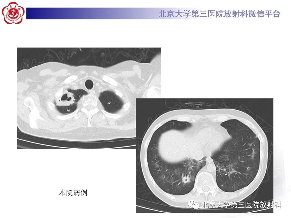 影像PPT - 【PPT】肺放线菌-23