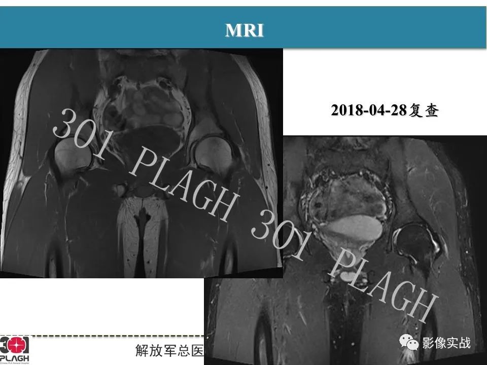 影像PPT - 【病例】股骨头一过性骨髓水肿1例X线MR-5