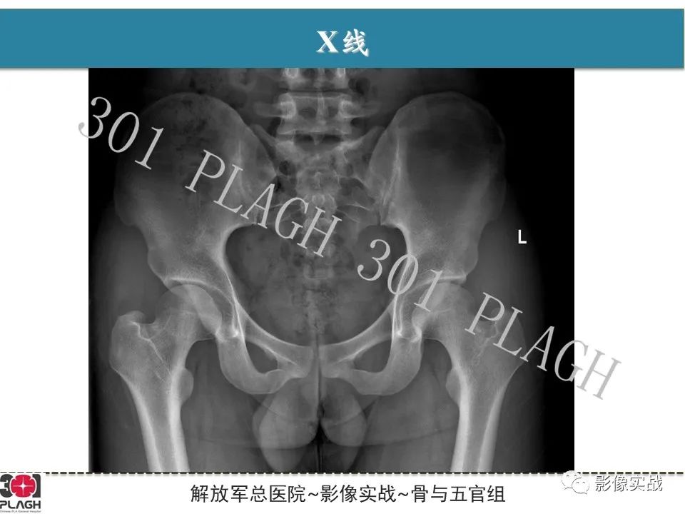 影像PPT - 【病例】股骨头一过性骨髓水肿1例X线MR-3