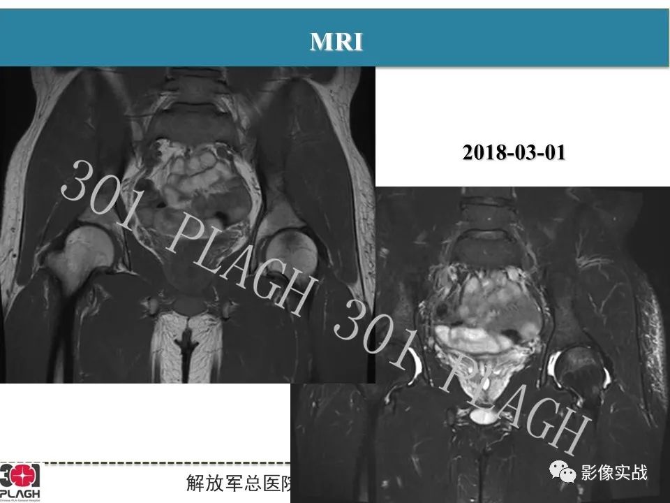 影像PPT - 【病例】股骨头一过性骨髓水肿1例X线MR-4
