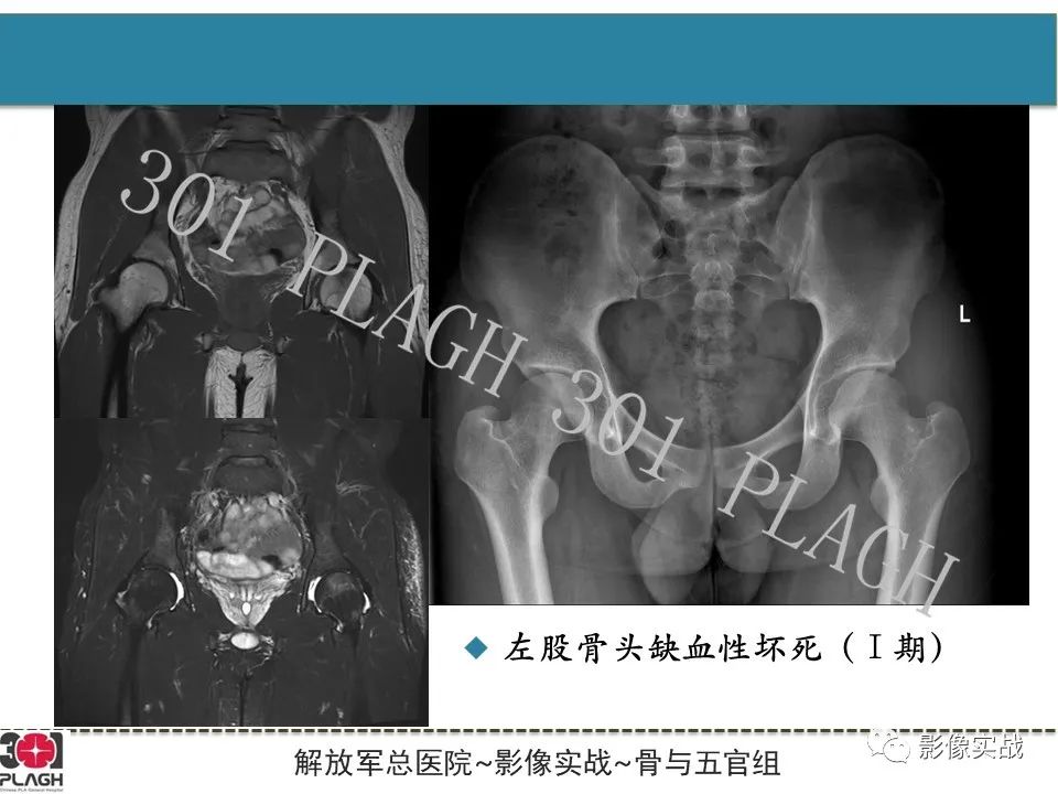 影像PPT - 【病例】股骨头一过性骨髓水肿1例X线MR-15