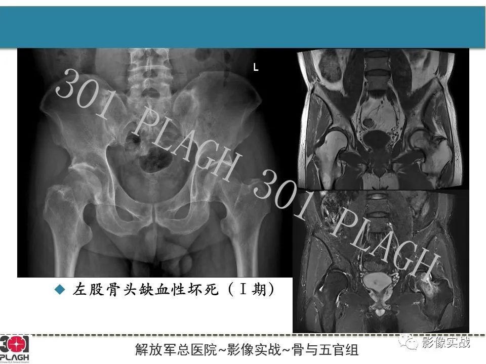 影像PPT - 【病例】股骨头一过性骨髓水肿1例X线MR-16