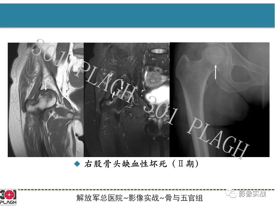 影像PPT - 【病例】股骨头一过性骨髓水肿1例X线MR-19