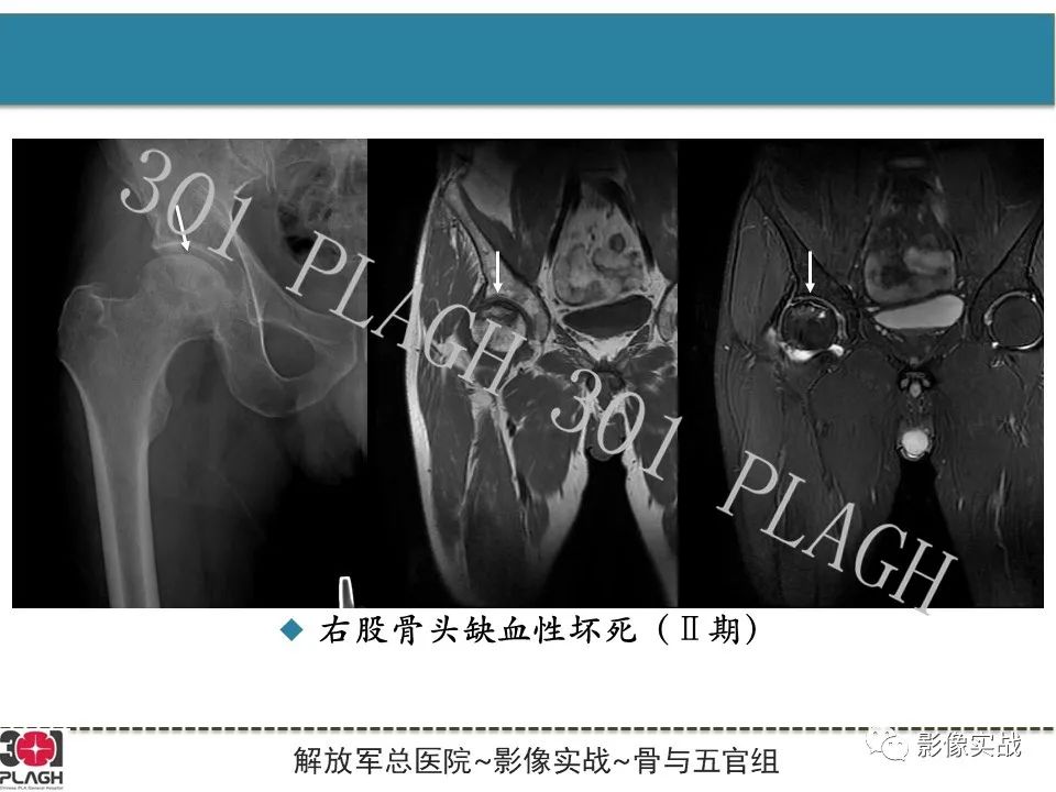 影像PPT - 【病例】股骨头一过性骨髓水肿1例X线MR-18