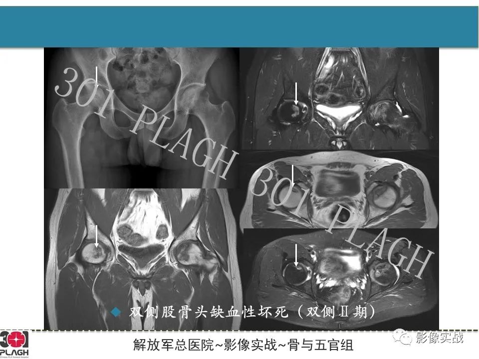 影像PPT - 【病例】股骨头一过性骨髓水肿1例X线MR-20