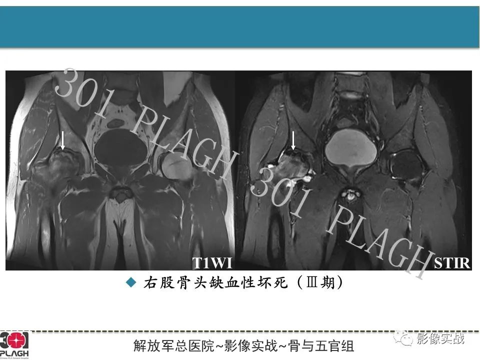 影像PPT - 【病例】股骨头一过性骨髓水肿1例X线MR-22