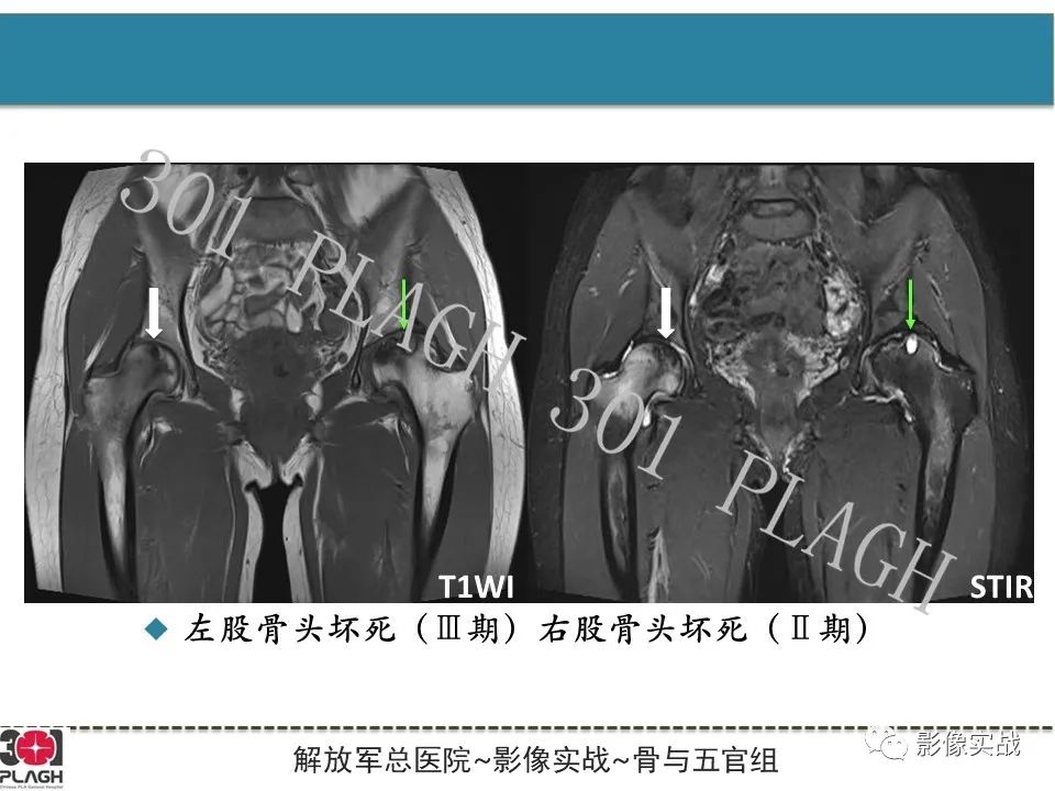 影像PPT - 【病例】股骨头一过性骨髓水肿1例X线MR-23