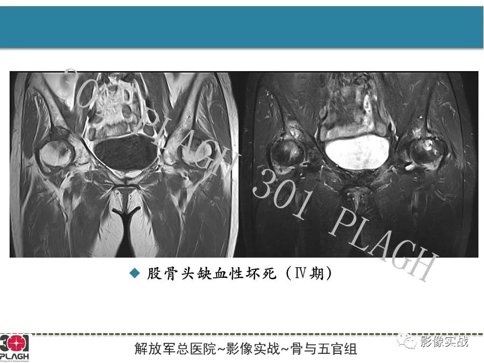 影像PPT - 【病例】股骨头一过性骨髓水肿1例X线MR-25