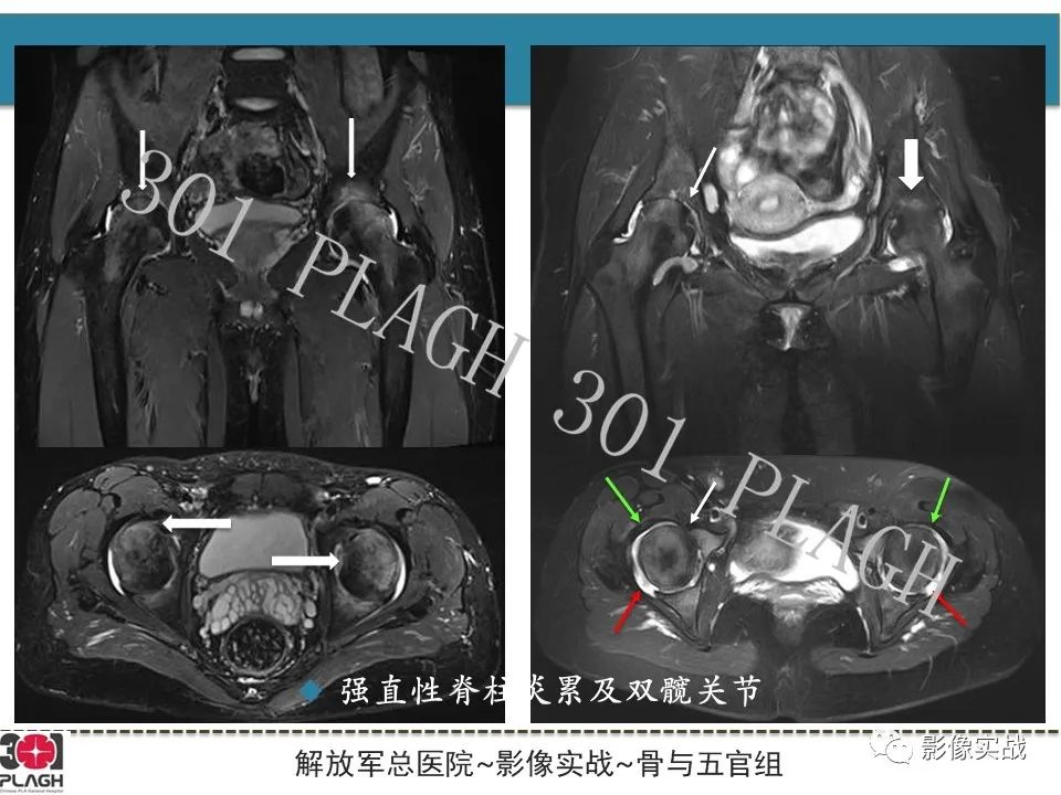 影像PPT - 【病例】股骨头一过性骨髓水肿1例X线MR-28