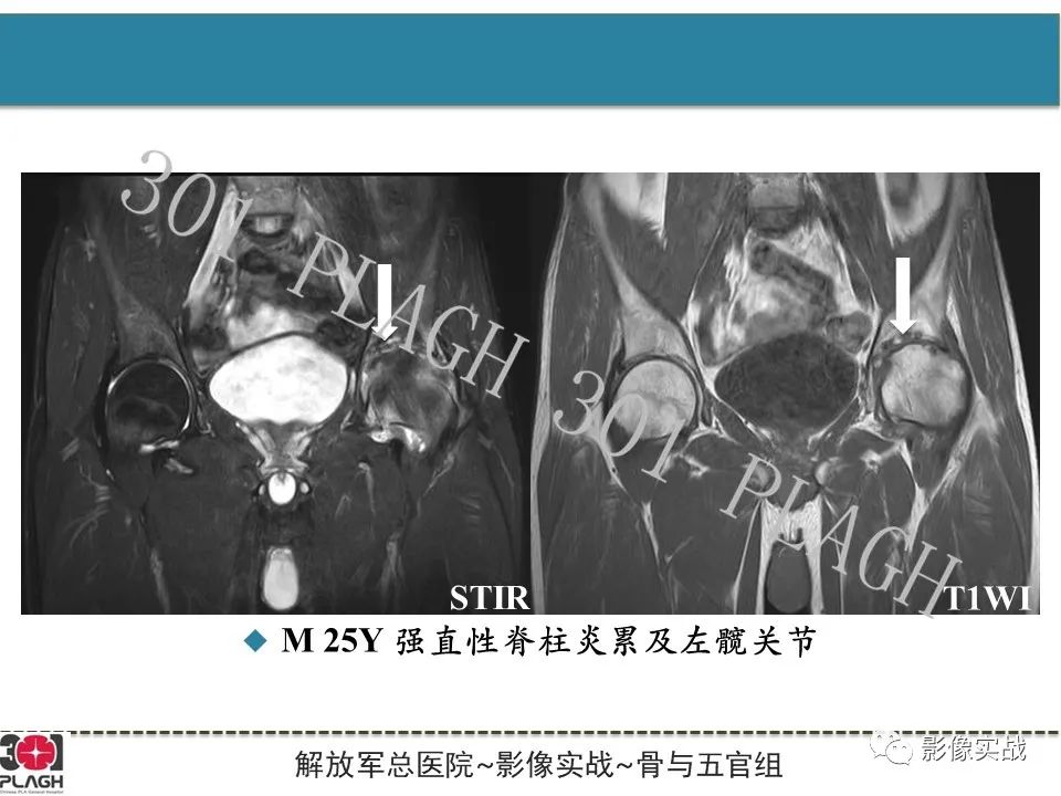 影像PPT - 【病例】股骨头一过性骨髓水肿1例X线MR-27