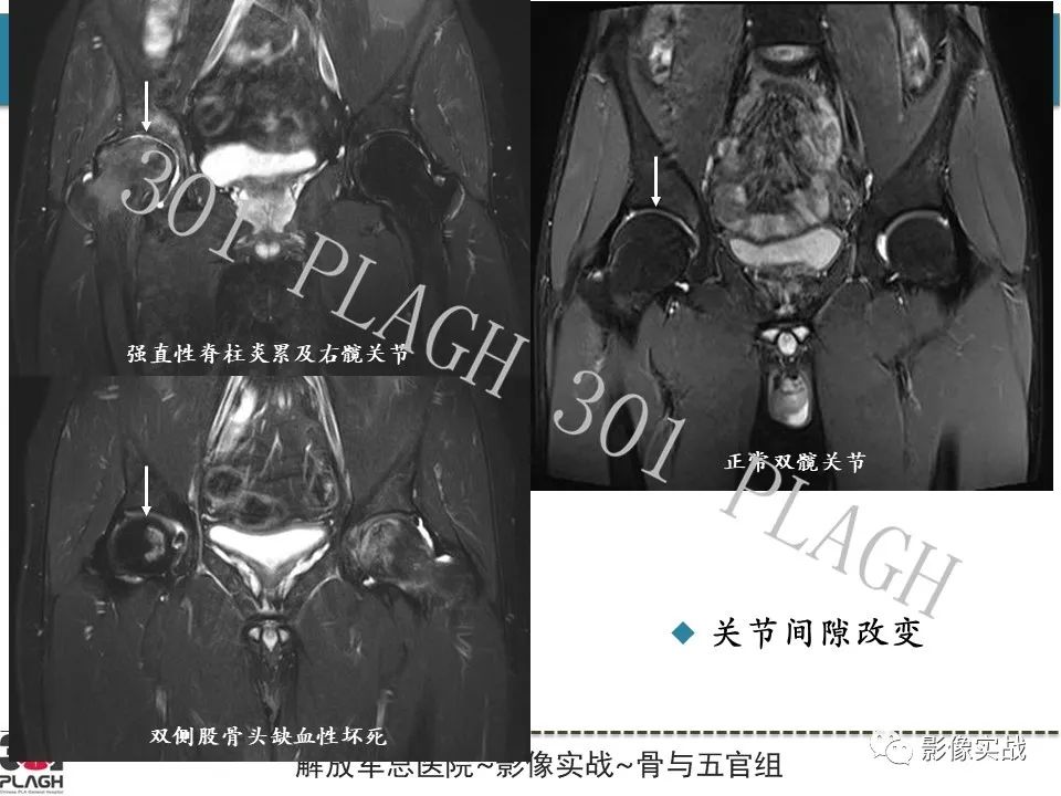 影像PPT - 【病例】股骨头一过性骨髓水肿1例X线MR-30
