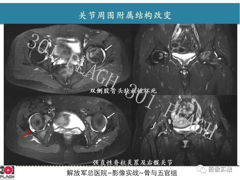 影像PPT - 【病例】股骨头一过性骨髓水肿1例X线MR-31