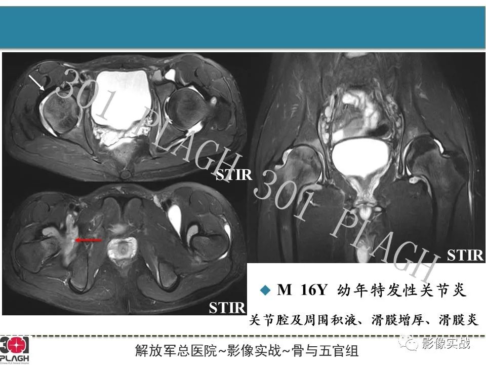 影像PPT - 【病例】股骨头一过性骨髓水肿1例X线MR-32