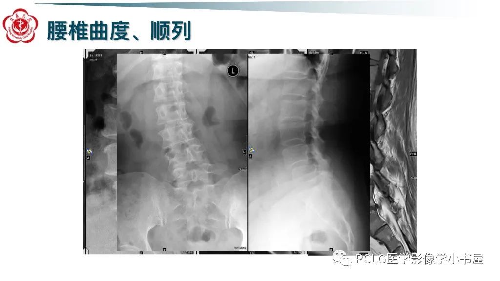 影像PPT - 【PPT】腰椎退行性病变影像读片思路-4